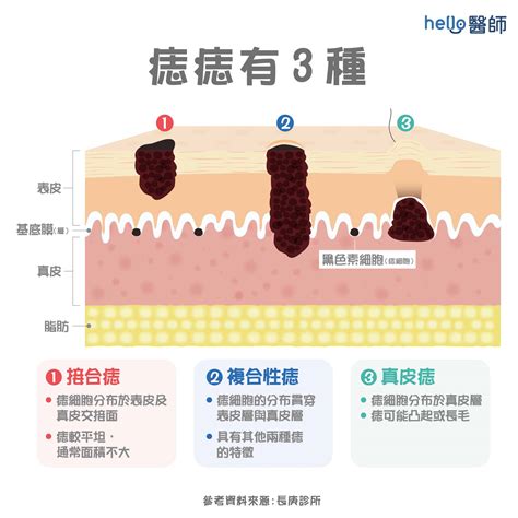 胸部長痣|痣形成的原因？痣長毛、痣變多變大是痣病變？5招判。